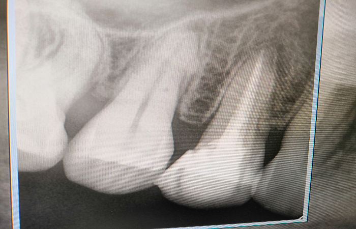 endodontie