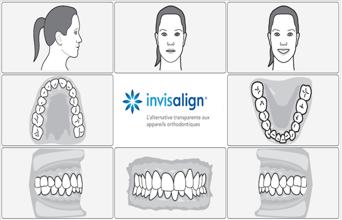 invisalign